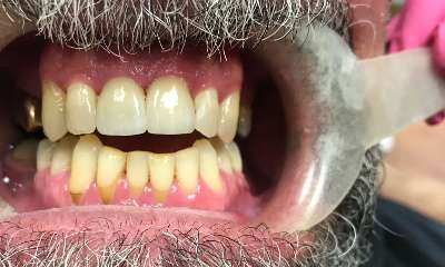 After treatment - Crowns and Bridges