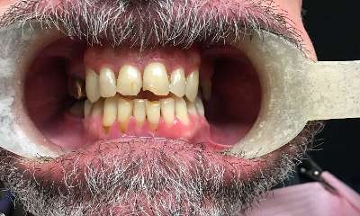 Before treatment - Crowns and Bridges